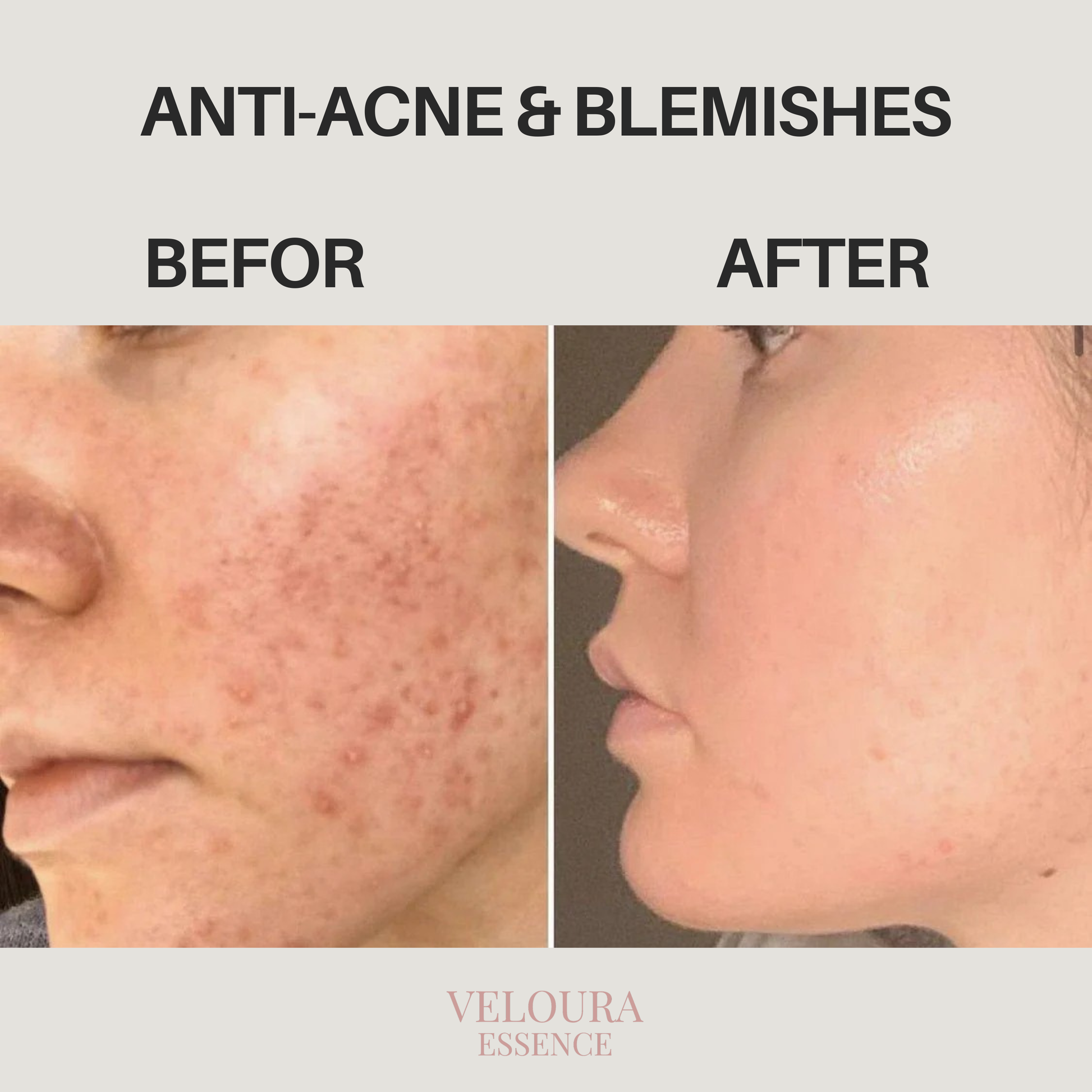 Anti-Acne & Blemishes
