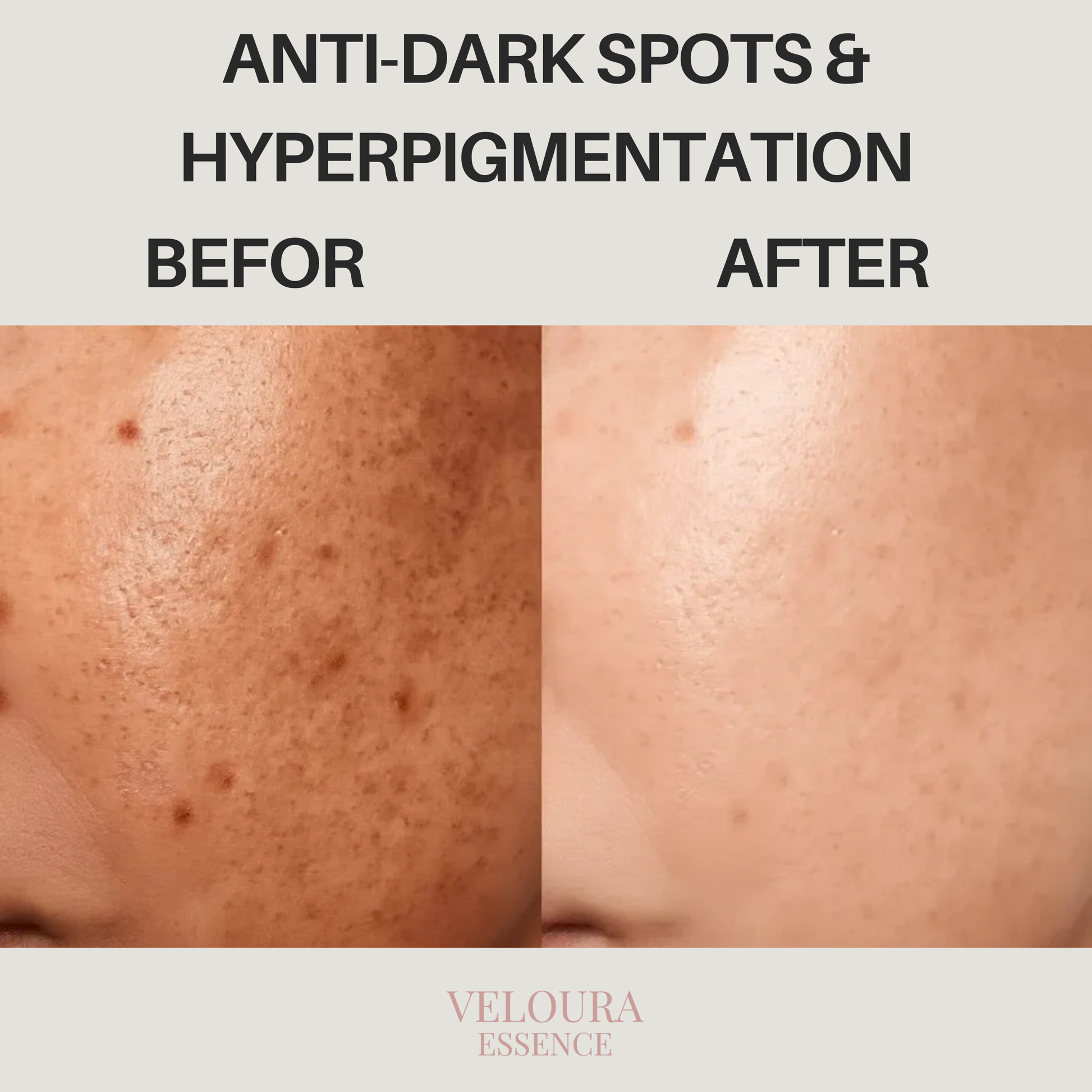 Anti-Dark Spots & Hyperpigmentation