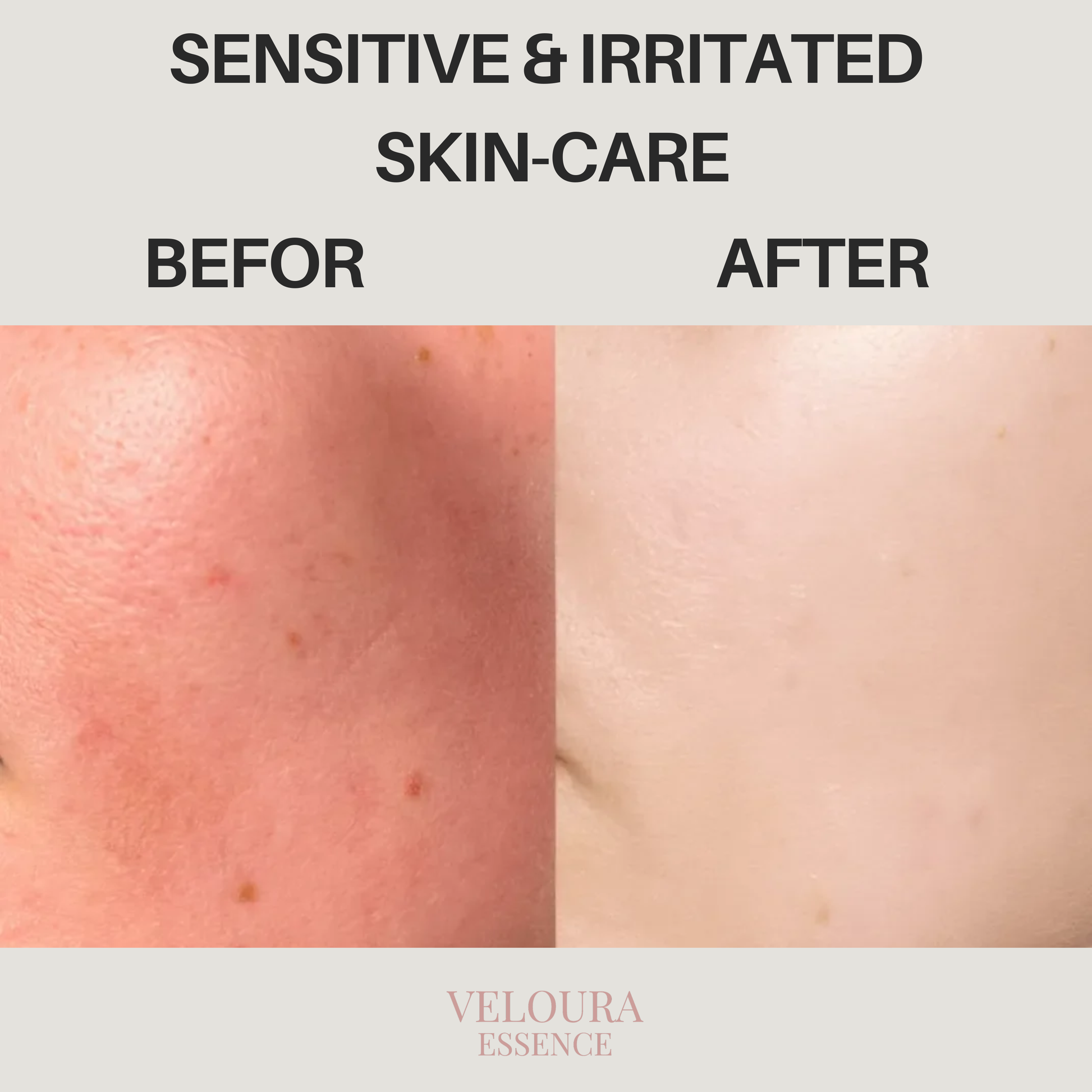 Sensitive & Irritated Skin-care